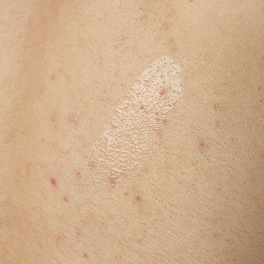 Salicylic Acid 0.5% Body Serum Acne Body Care - Image 4