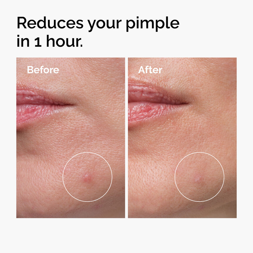 Sulfur 10% Powder-to-Cream Concentrate Acne Treatment - Image 6